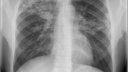 Commissie voor Praktische Tuberculosebestrijding (CPT) | RIVM