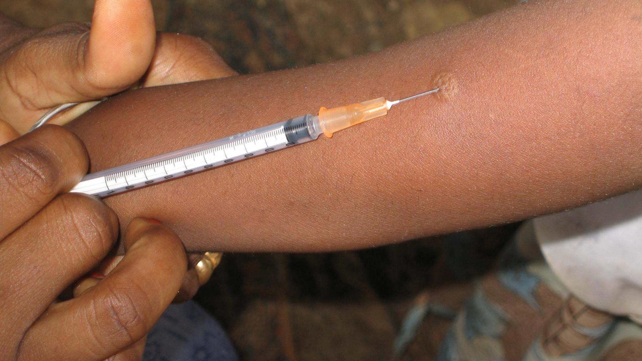 Performance of TB skin test on a child's arm